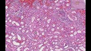 Histopathology KidneyInterstitial nephritis [upl. by Lyns]