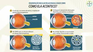 Degeneração Macular [upl. by Eniluap930]