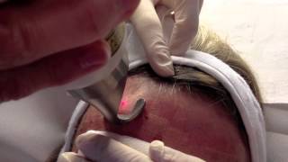 Resurfacing dermabrasion du visage au laser Erbium [upl. by Aronaele]