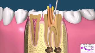 ENDODONCIA MANUAL POSTE COMPO CORONA [upl. by York574]