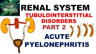 ACUTE PYELONEPHRITIS Pathology [upl. by Gherlein]