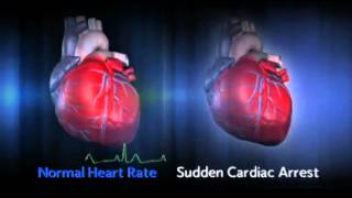 Sudden Cardiac Arrest SCA [upl. by Asereht378]