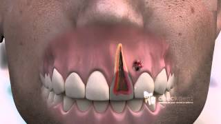 How to treat a dental Fistula [upl. by Strohbehn]