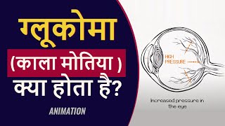 What is Glaucoma  क्‍या है ग्‍लूकोमा या काला मोतिया [upl. by Defant]