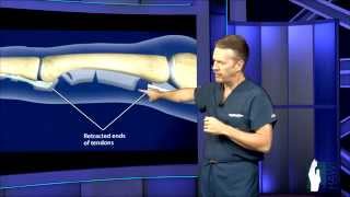 Extensor Tendon Surgery [upl. by Aimas]