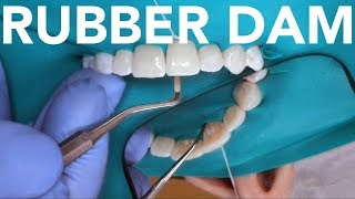 Rubber Dam Placement for Anterior amp Posterior Teeth [upl. by Haggar276]