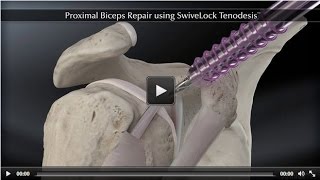 Proximal Biceps Repair using SwiveLock® Tenodesis [upl. by Sidney]