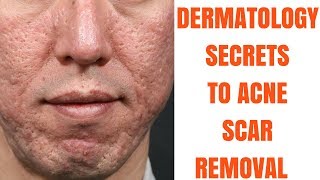 Acne Scar Creams  Dermatologist Reviews [upl. by Annoyed]