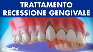 Gengive ritirate  Trattamento recessione gengivale © [upl. by Petra]