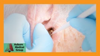 Chucks Tough Ear Wax Removal Part 1  Auburn Medical Group [upl. by Ariuqahs]