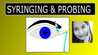 Lacrimal Syringing amp Probing  Procedure amp Interpretation of Results [upl. by Nahsab330]