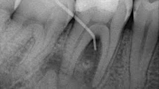 Endodoncia en Molar Inferior [upl. by Gipsy]