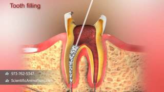 Root Canal Treatment [upl. by Etz515]