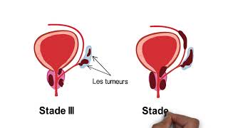 Comprendre le cancer de la prostate [upl. by Zacek]