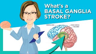 Basal Ganglia Stroke [upl. by Bethel]