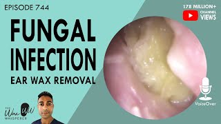 636  Profound Deafness Cured Post Ear Wax Removal [upl. by Lutim]