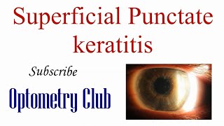 Superficial Punctate Keratitis Introduction Diagnosis and Treatment [upl. by Flemings209]